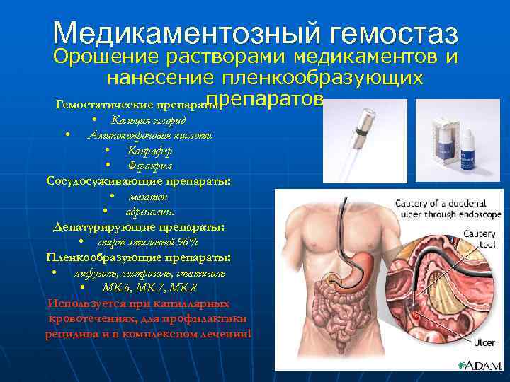 Медикаментозный гемостаз Орошение растворами медикаментов и нанесение пленкообразующих препаратов Гемостатические препараты: • Кальция хлорид