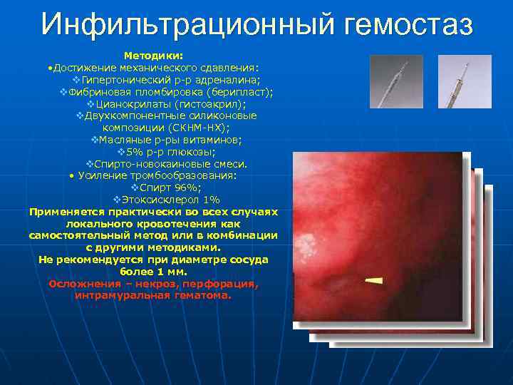 Инфильтрационный гемостаз Методики: • Достижение механического сдавления: v. Гипертонический р-р адреналина; v. Фибриновая пломбировка