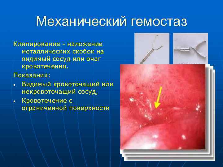 Механический гемостаз Клипирование - наложение металлических скобок на видимый сосуд или очаг кровотечения. Показания: