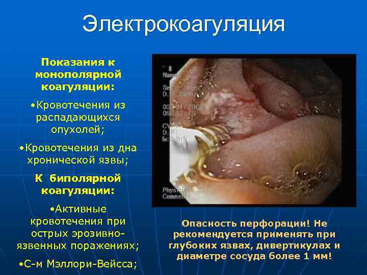Электрокоагуляция Показания к монополярной коагуляции: • Кровотечения из распадающихся опухолей; • Кровотечения из дна