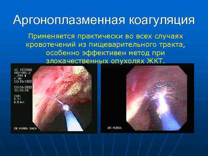 Аргоноплазменная коагуляция Применяется практически во всех случаях кровотечений из пищеварительного тракта, особенно эффективен метод