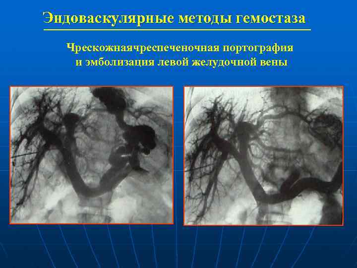 Эндоваскулярные методы гемостаза Чрескожнаячреспеченочная портография и эмболизация левой желудочной вены 