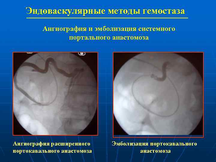Эндоваскулярные методы гемостаза Ангиография и эмболизация системного портального анастомоза Ангиография расширенного портокавального анастомоза Эмболизация