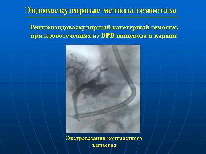 Эндоваскулярная окклюзия. Экстравазация контрастного вещества. Эндоваскулярные методы гемостаза. Эндоваскулярный метод. Рентгенэндоваскулярные методы диагностики.