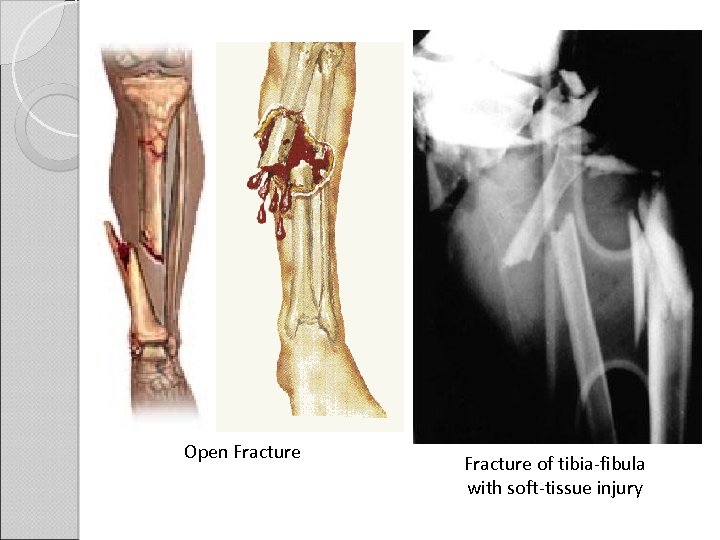 Open Fracture of tibia-fibula with soft-tissue injury 