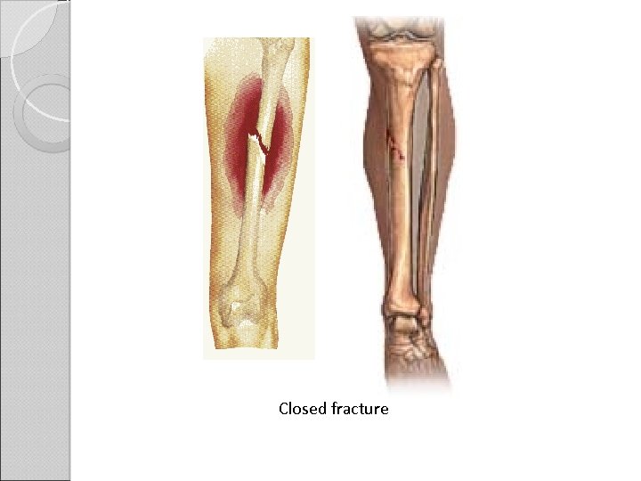 Closed fracture 