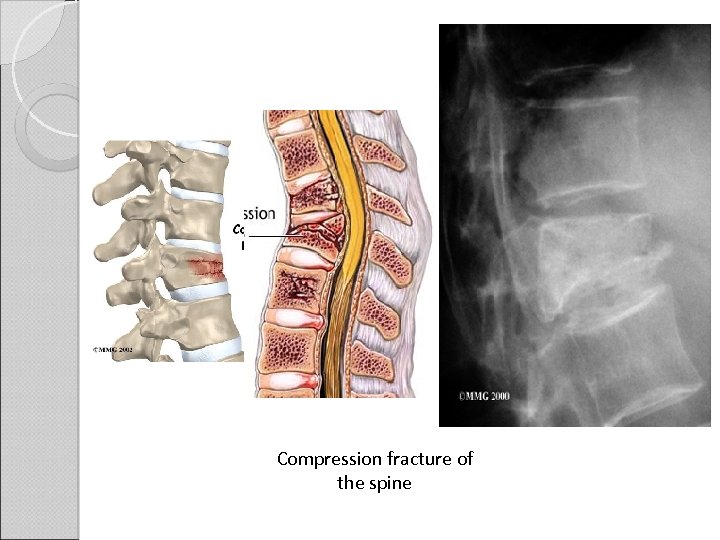 Compression fracture of the spine 