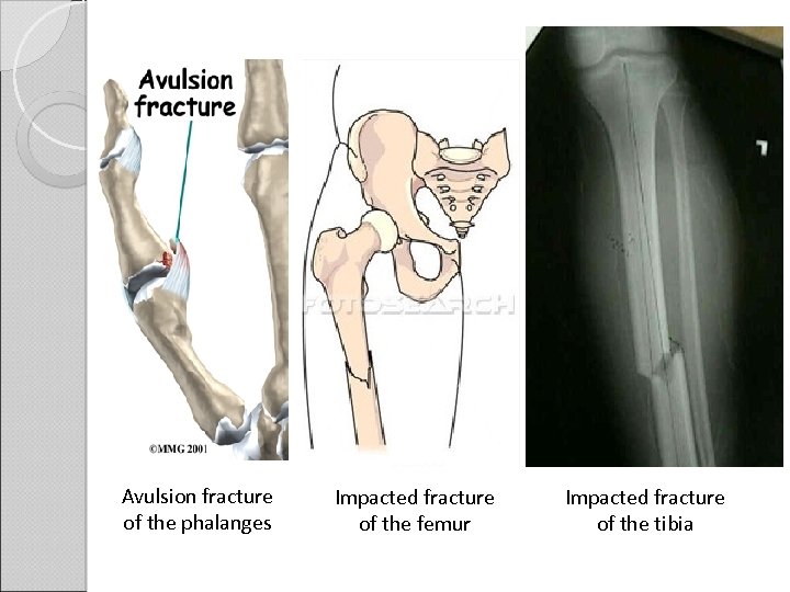 Avulsion fracture of the phalanges Impacted fracture of the femur Impacted fracture of the