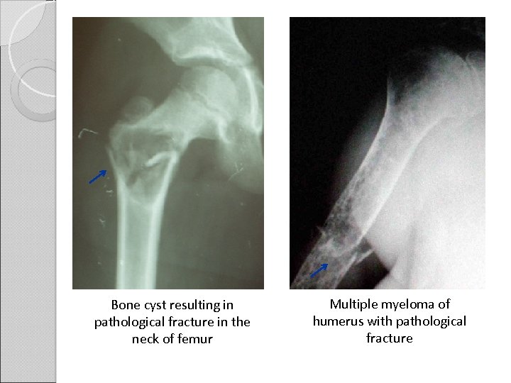 Bone cyst resulting in pathological fracture in the neck of femur Multiple myeloma of