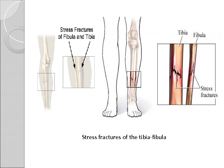 Stress fractures of the tibia-fibula 