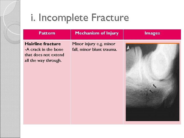 i. Incomplete Fracture Pattern Hairline fracture -A crack in the bone that does not