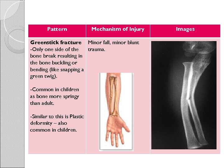 Pattern Mechanism of Injury Greenstick fracture Minor fall, minor blunt -Only one side of