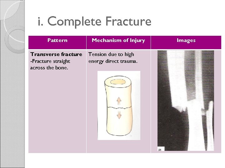 i. Complete Fracture Pattern Transverse fracture -Fracture straight across the bone. Mechanism of Injury