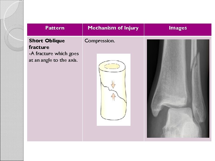 Pattern Short Oblique fracture -A fracture which goes at an angle to the axis.