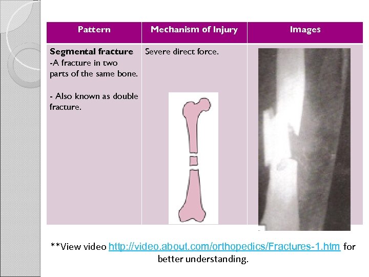 Pattern Mechanism of Injury Images Segmental fracture Severe direct force. -A fracture in two