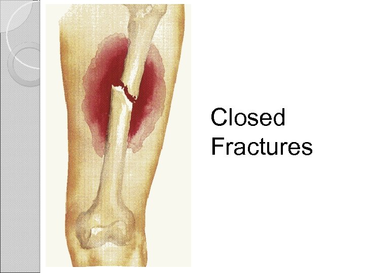 Closed Fractures 