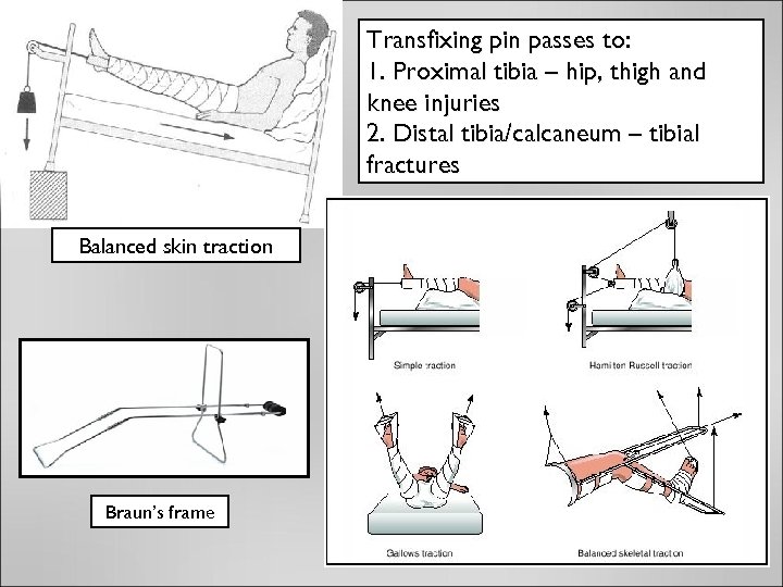 Transfixing pin passes to: 1. Proximal tibia – hip, thigh and knee injuries 2.