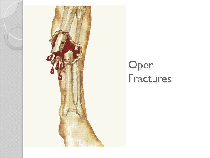 Open Fractures 