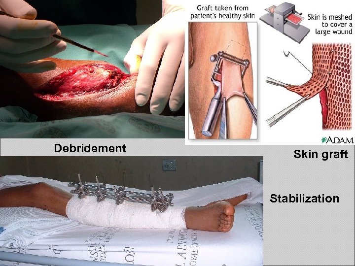Debridement Skin graft Stabilization 