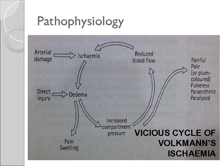 Pathophysiology VICIOUS CYCLE OF VOLKMANN’S ISCHAEMIA 