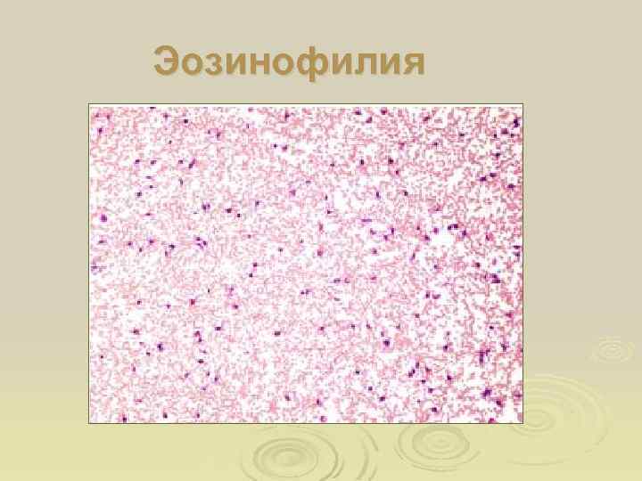 Эозинофилия 