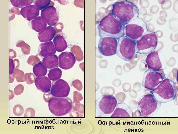Острый лимфобластный лейкоз Острый миелобластный лейкоз 