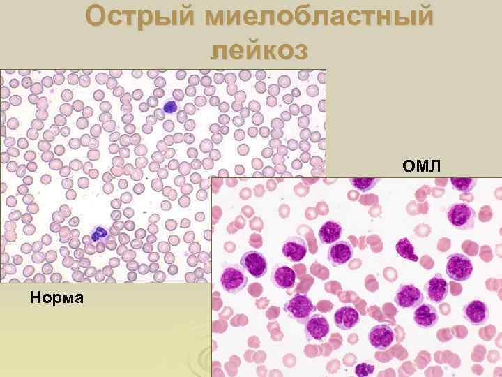 Острый миелобластный лейкоз ОМЛ Норма 
