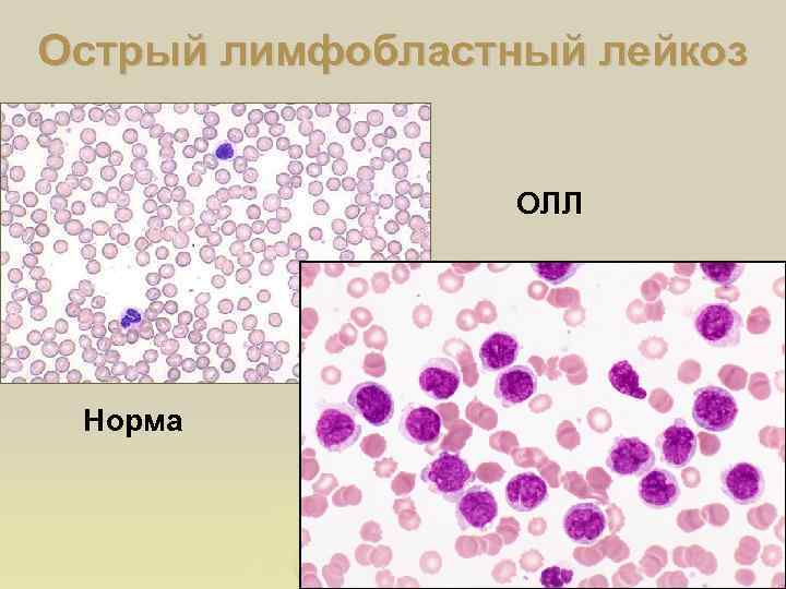 Острый лимфобластный лейкоз ОЛЛ Норма 