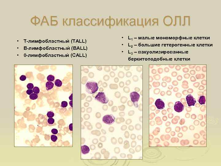 ФАБ классификация ОЛЛ • Т-лимфобластный (TALL) • В-лимфобластный (ВALL) • 0 -лимфобластный (CALL) •