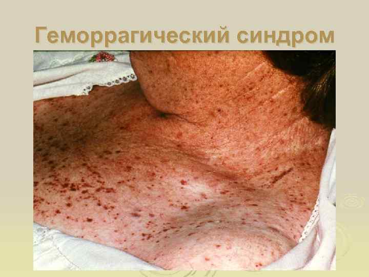 Геморрагический синдром 