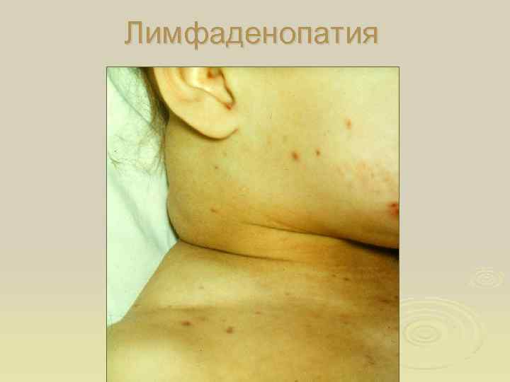 Лимфаденопатия 