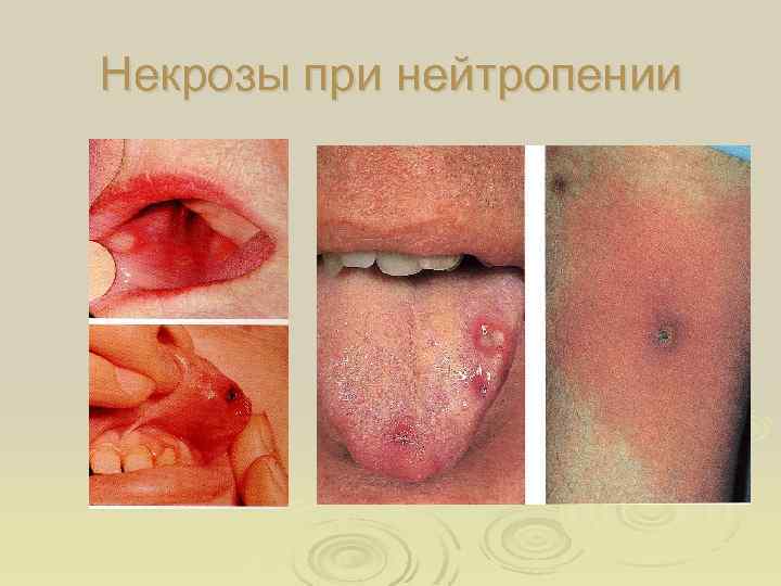 Некрозы при нейтропении 