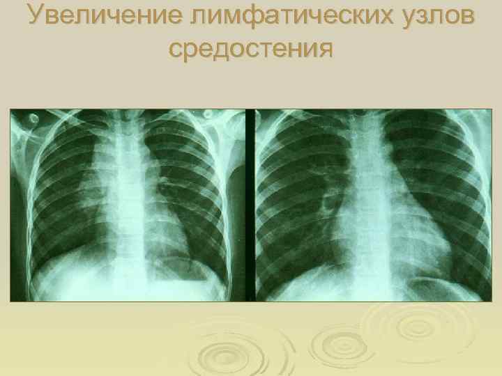 Увеличение лимфатических узлов средостения 