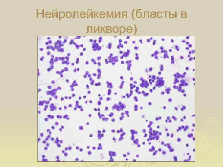 Нейролейкемия (бласты в ликворе) 