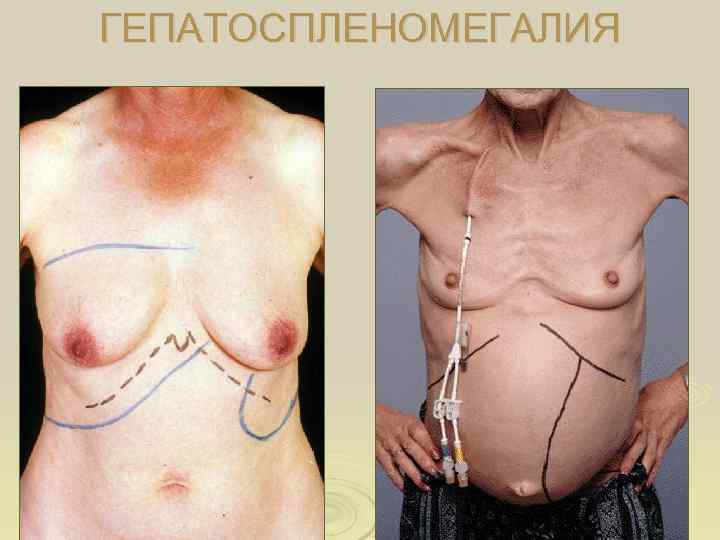 ГЕПАТОСПЛЕНОМЕГАЛИЯ 