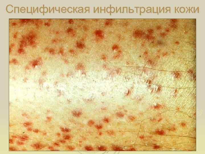 Специфическая инфильтрация кожи 