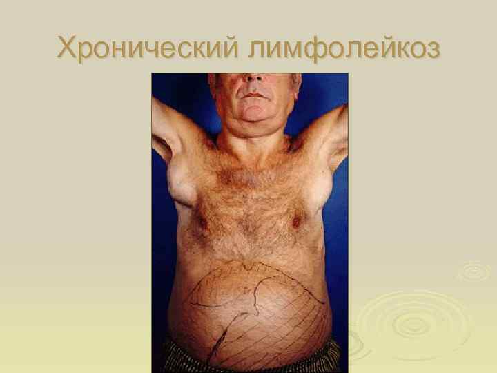 Хронический лимфолейкоз 