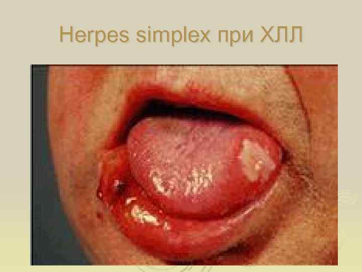 Herpes simplex при ХЛЛ 