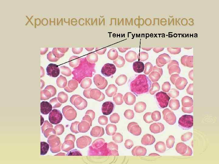 Хронический лимфолейкоз Тени Гумпрехта-Боткина 