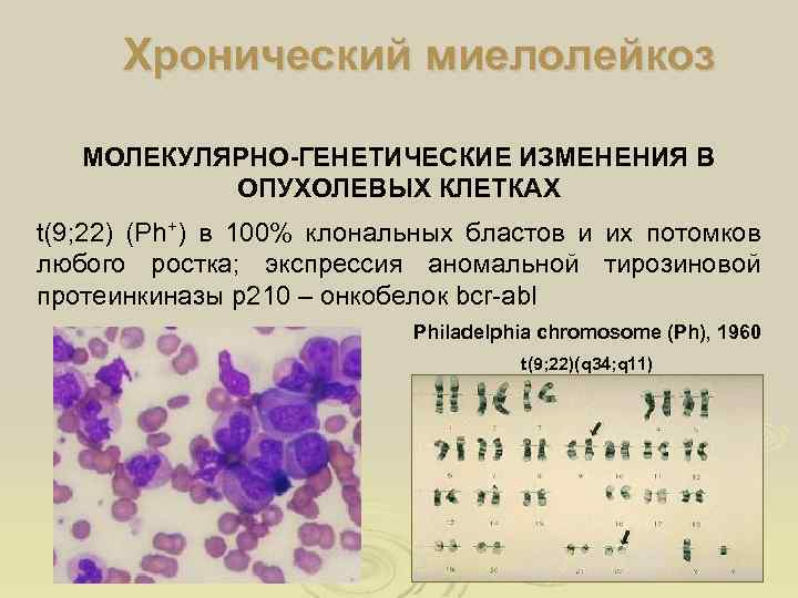 Хронический миелолейкоз МОЛЕКУЛЯРНО-ГЕНЕТИЧЕСКИЕ ИЗМЕНЕНИЯ В ОПУХОЛЕВЫХ КЛЕТКАХ t(9; 22) (Ph+) в 100% клональных бластов