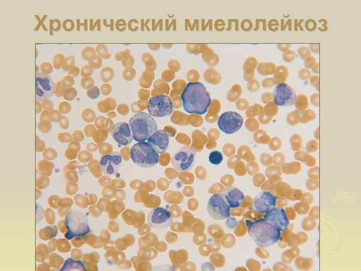 Хронический миелолейкоз 