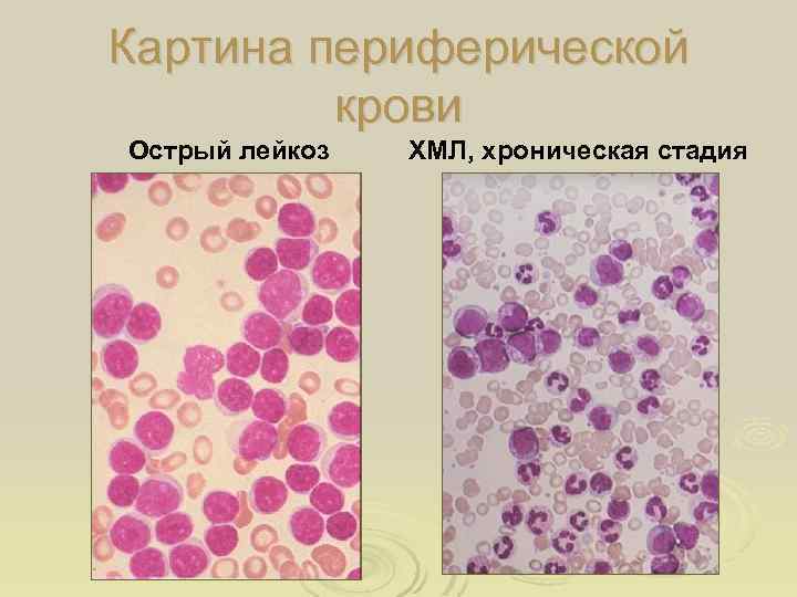 Картина периферической крови