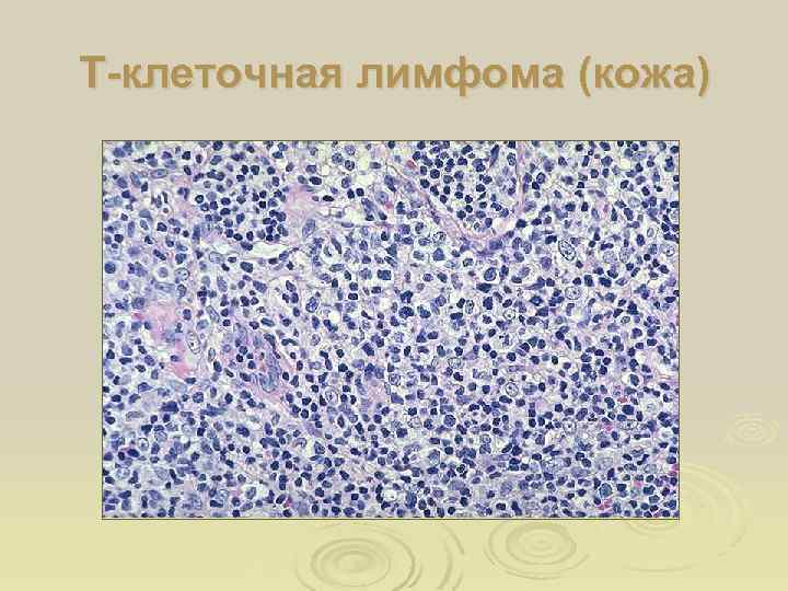 Т-клеточная лимфома (кожа) 
