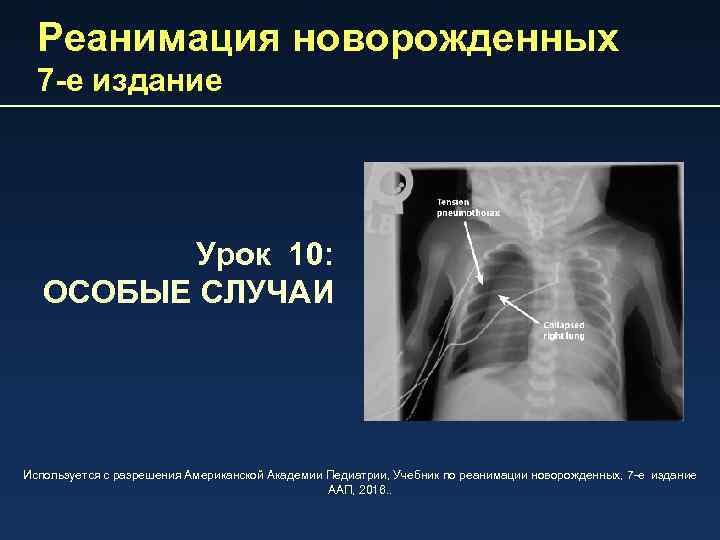 Реанимация новорожденных 7 -е издание Урок 10: ОСОБЫЕ СЛУЧАИ Используется с разрешения Американской Академии