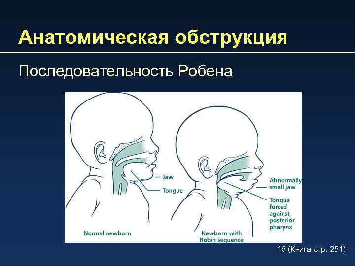 Анатомическая обструкция Последовательность Робена 15 (Книга стp. 251) 