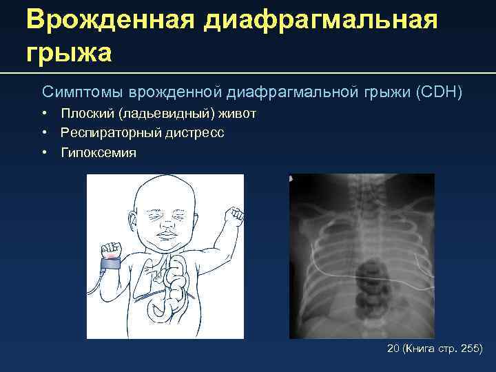 Врожденная диафрагмальная грыжа Симптомы врожденной диафрагмальной грыжи (CDH) • Плоский (ладьевидный) живот • Респираторный