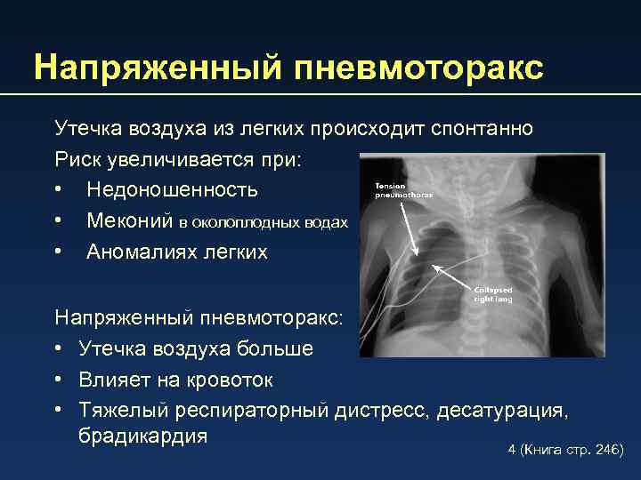 Напряженный пневмоторакс Утечка воздуха из легких происходит спонтанно Риск увеличивается при: • Недоношенность •