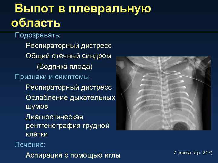 Выпот в плевральную область Подозревать: Респираторный дистресс Общий отечный синдром (Водянка плода) Признаки и