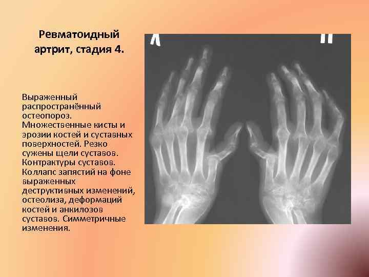 Артрит рентгенологические стадии