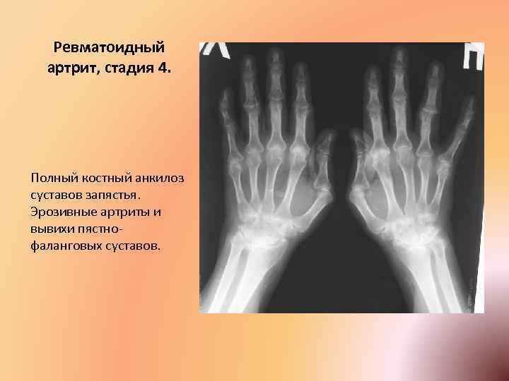 Ревматоидный артрит степени. Рентгенологические стадии ра по Штейброкеру.